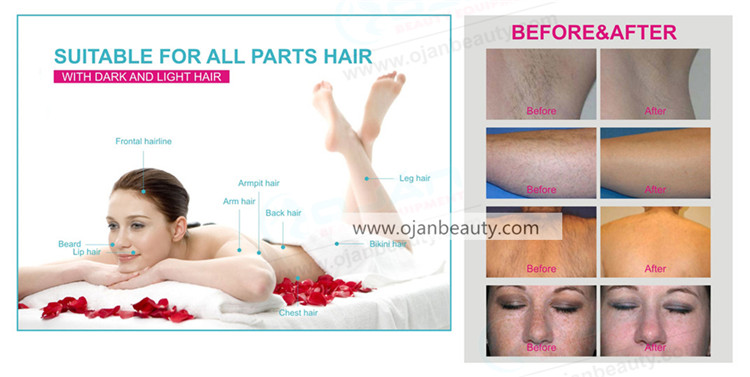  Alexandrite Diode Laser Hair Removal machine factory 